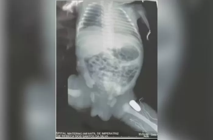 Homem suspeito por disparar em adolescente grávida, é preso em Imperatriz no Maranhão 