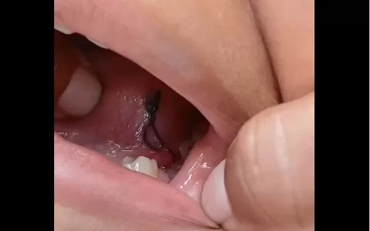  Mãe leva filho para extrair dente e dentista costura a lingua da criança na UBS