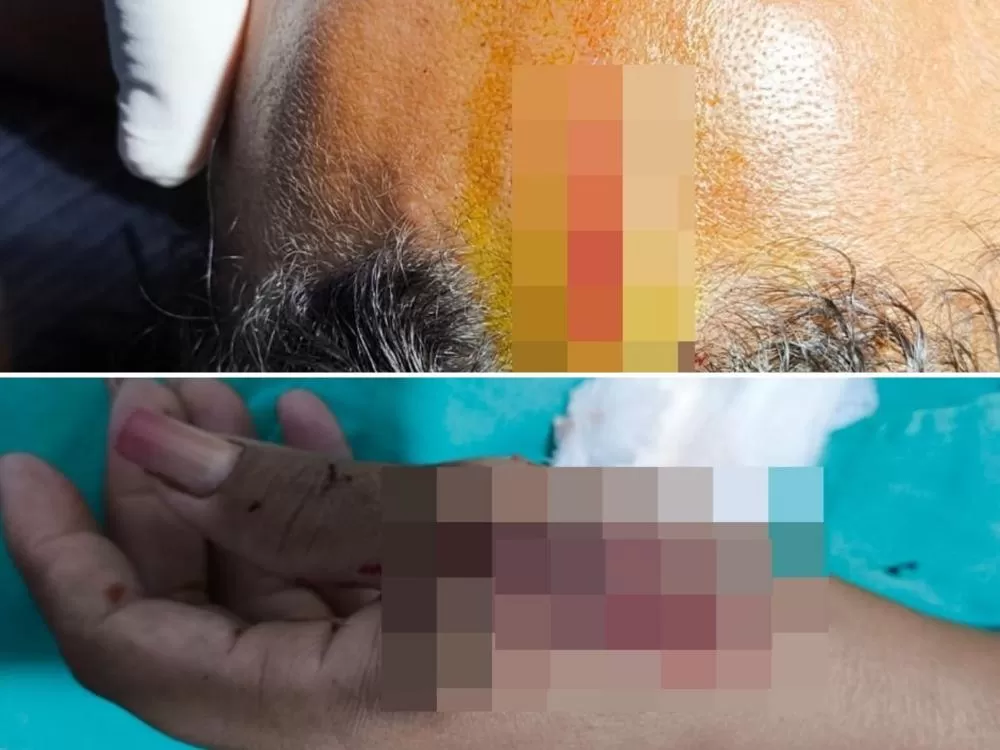 Mulher sofre ataque brutal com facão do companheiro na zona rural de Batalha