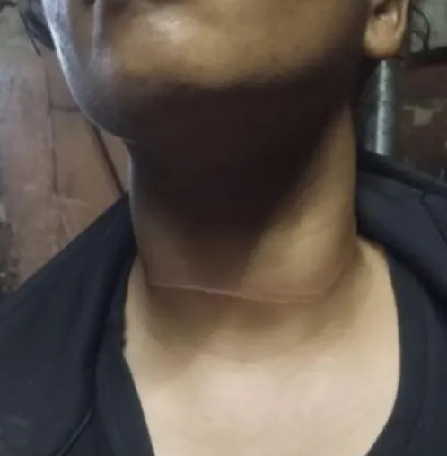 Linha com cerol fere jovem em motocicleta na BR-343, em Piripiri