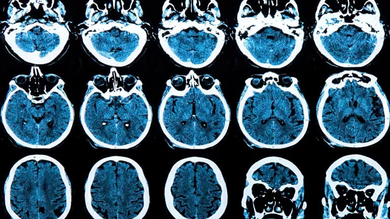 Terapia genética mostra potencial para frear avanço da doença de Huntington