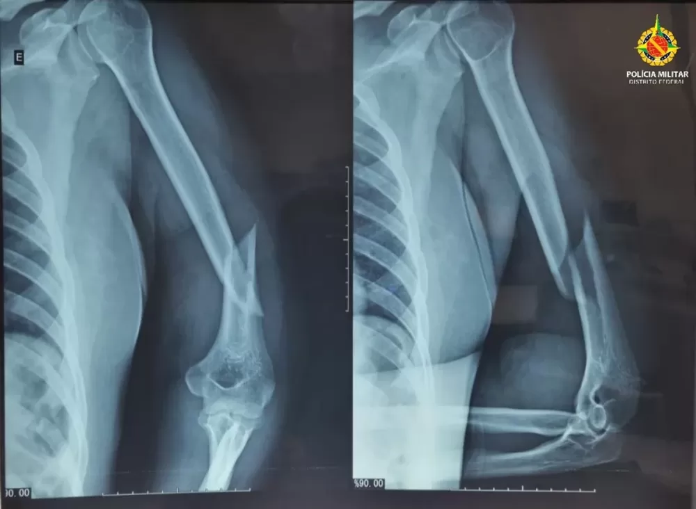 Carroceiro é preso após espancar e torturar mulher durante 6 horas no DF